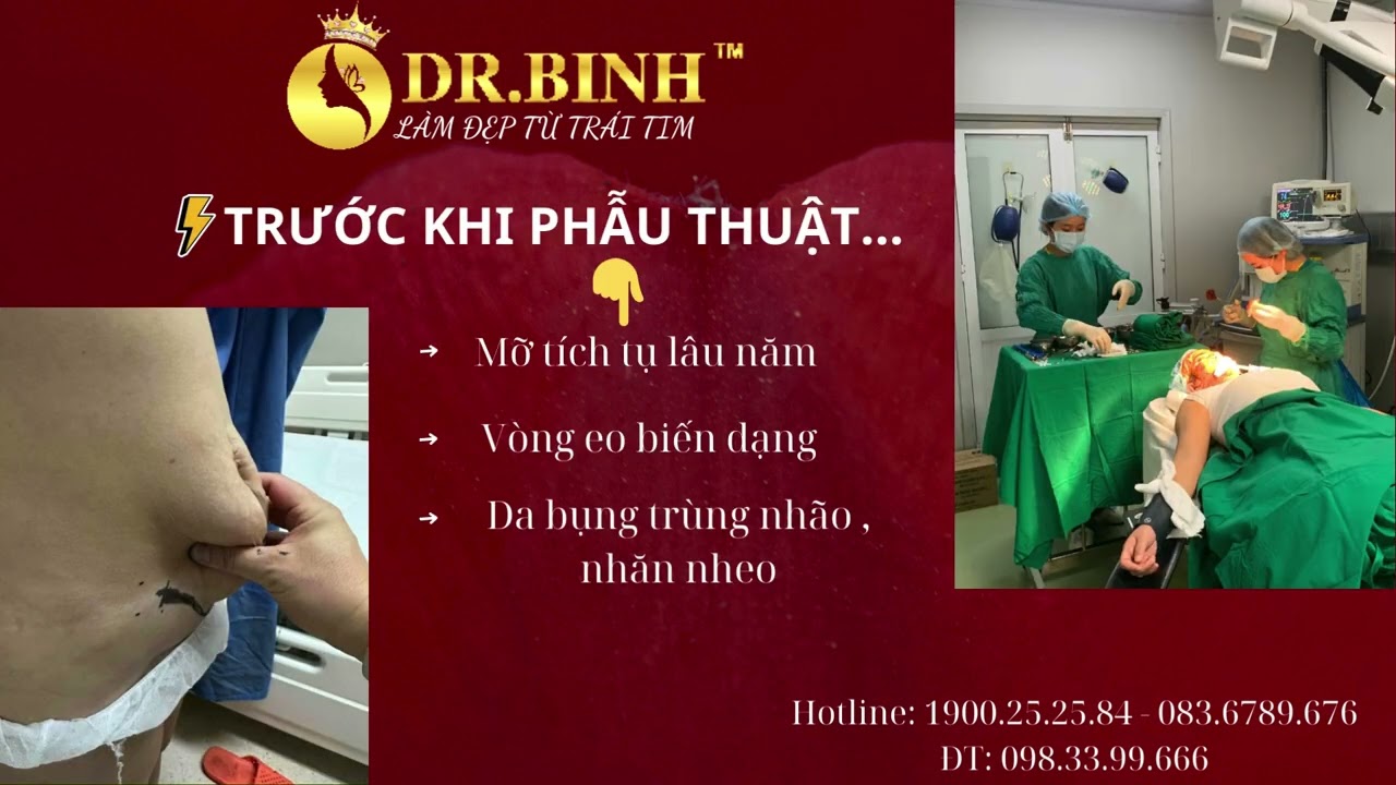 Tạo h&igrave;nh th&agrave;nh bụng tại Dr.B&igrave;nh