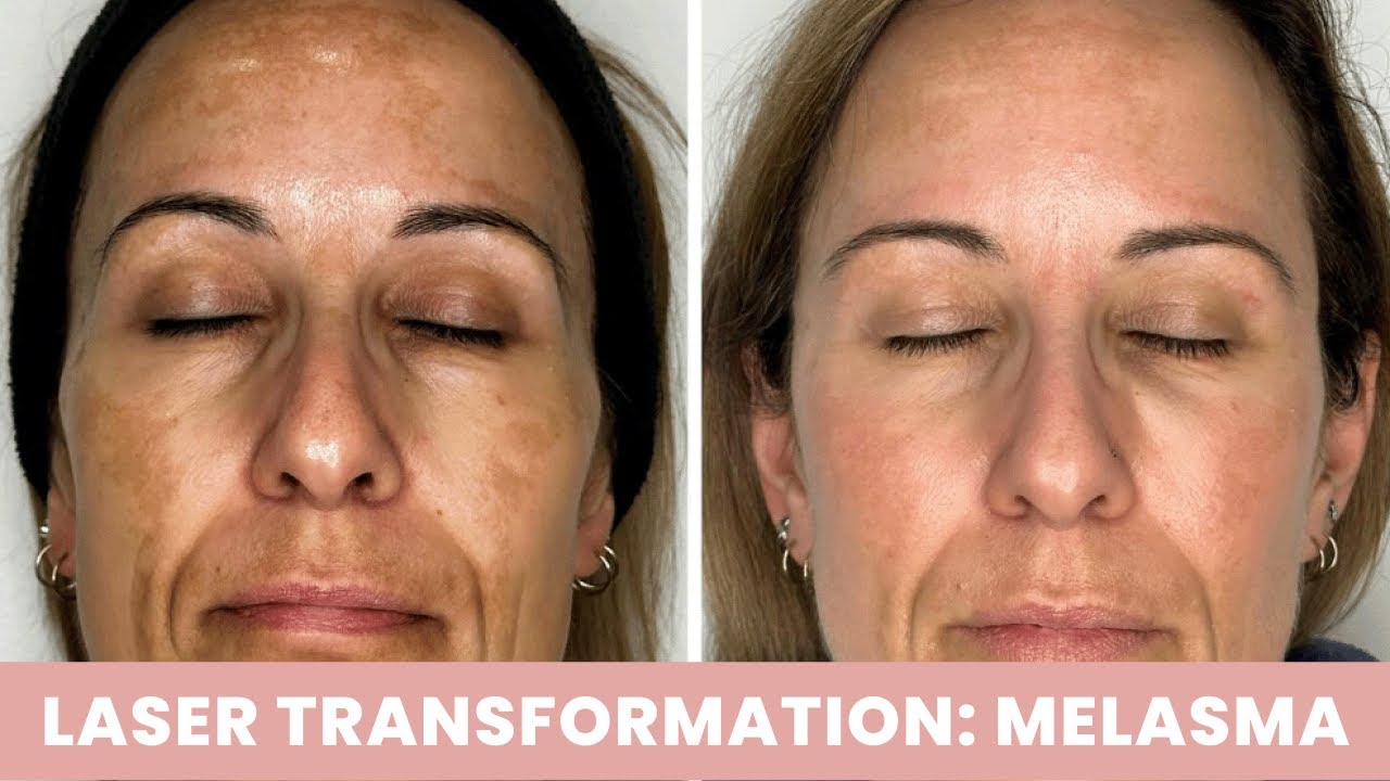 How To Get Rid of Melasma