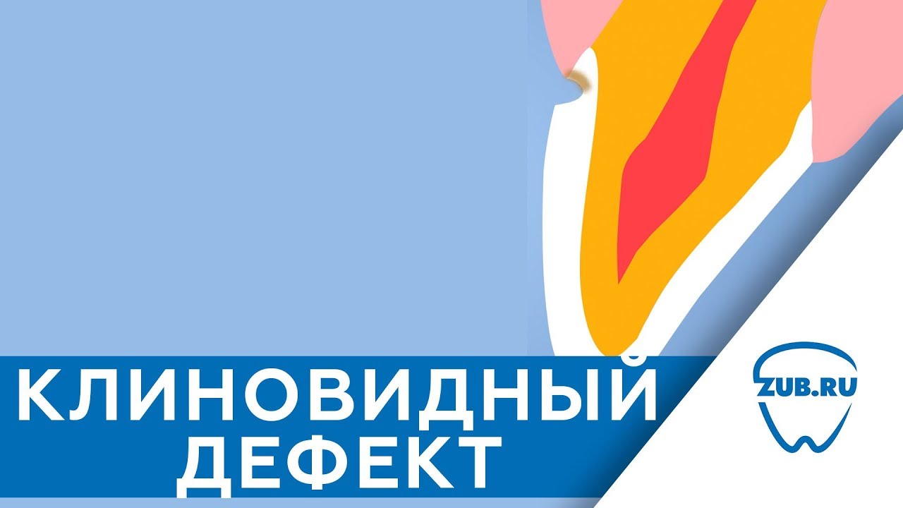 Клиновидный дефект