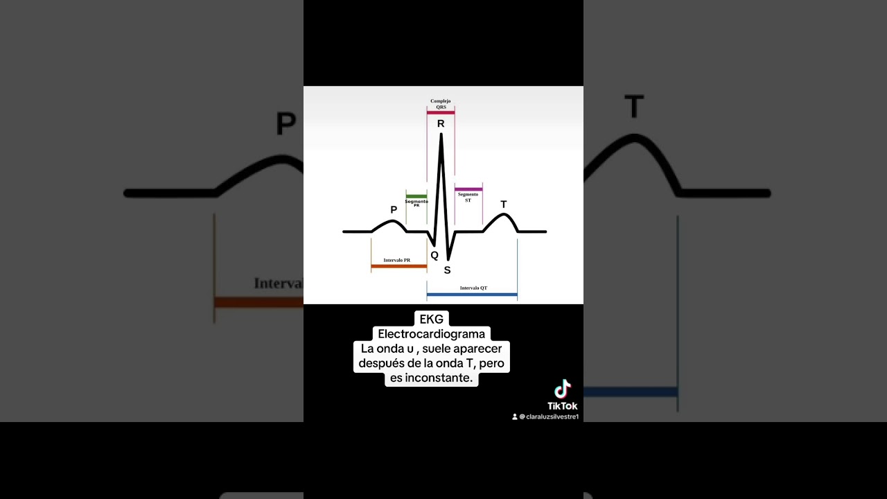 #EKG##ondas de ekg#intervalo ekg#segmentos ekg#CMA ekg