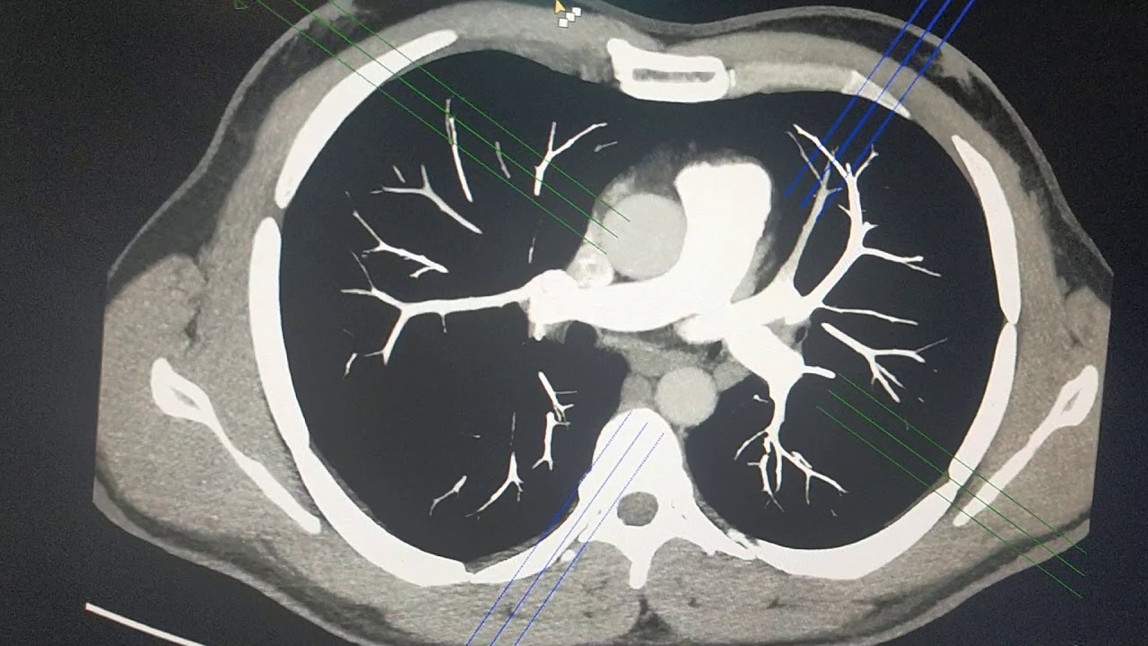 الأشعة المقطعية علي الشريان الرئوي C T Pulmonary angiography