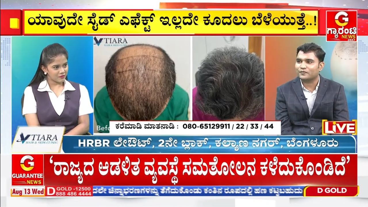 Best Hair Transplant in Bangalore- Kannada | Vtiara Hair and Skin Clinic 