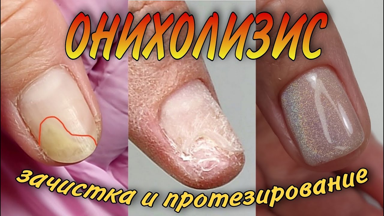 онихолизис\зачистка и протезирование