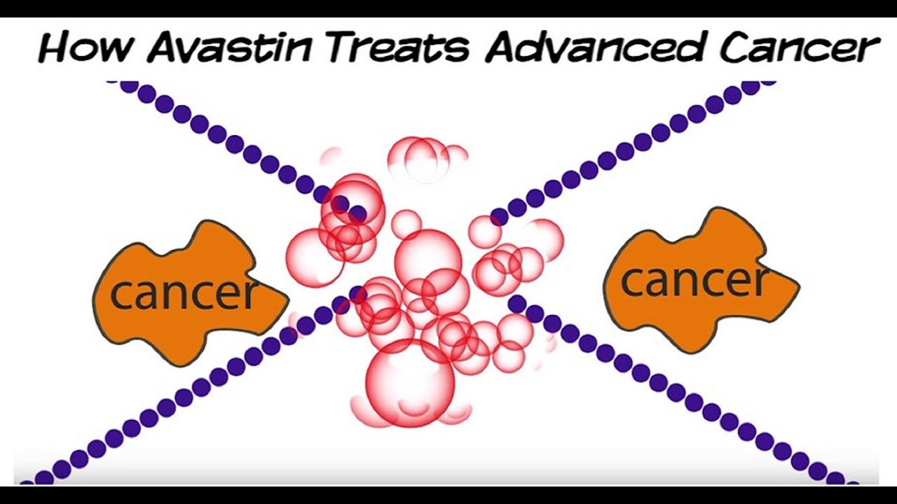 How Avastin (Bevacizumab) Targeted Therapy Treats Advanced Cancer