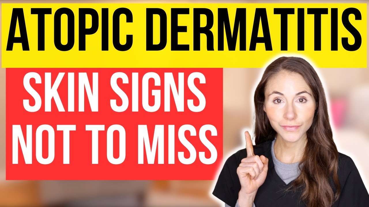 Don't Miss These 15 Signs Of Atopic Dermatitis!