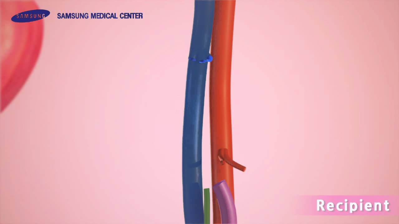 뇌사자 간이식 영상[3D Medical Contents]