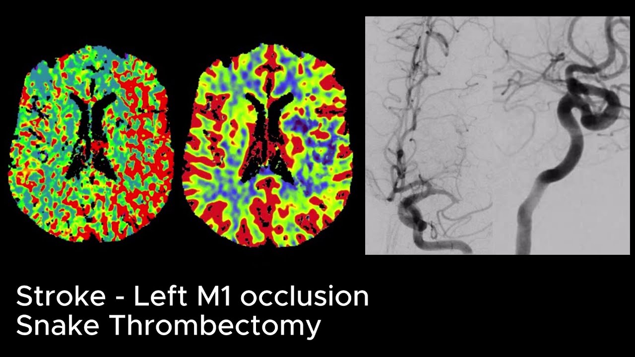 Stroke - Left M1 - Snake
