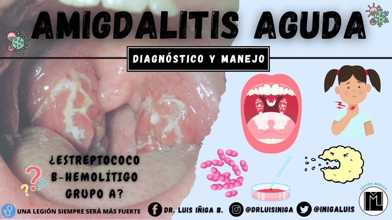 Faringoamigdalitis aguda | Etiología, Patogenia, Clínica, Diagnóstico y Tratamiento ¿EBHGA?