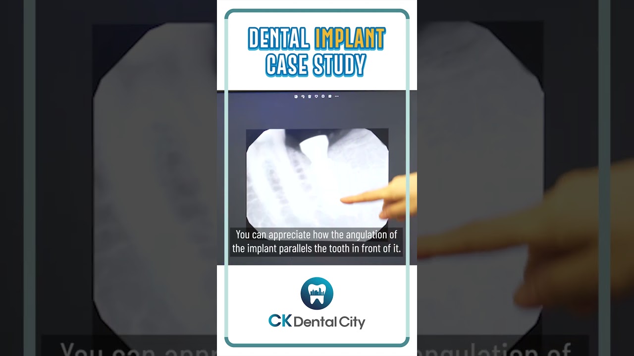 [CK Dental City] Dental Implant Case Study