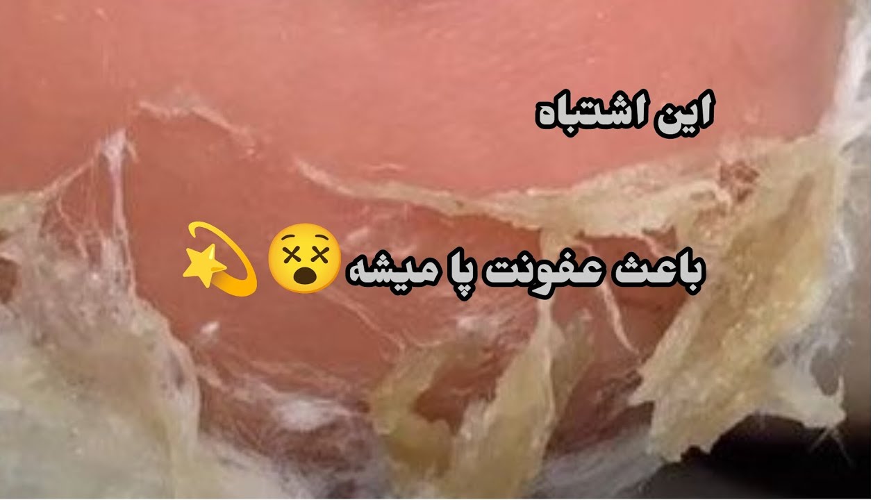 آموزش اصولی کالوس تراپی💥نحوه صحیح پدیکور#pedicure