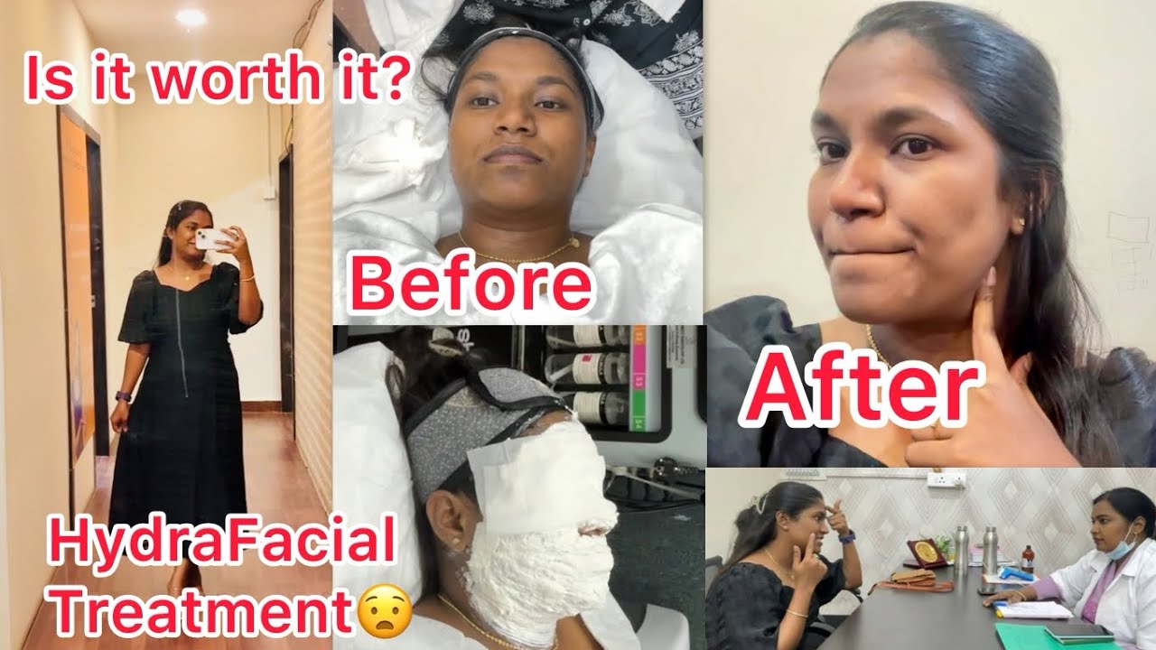 Hydra Facial Treatment || Before & After Results || Doctor Consultation || Step by Step Procedure