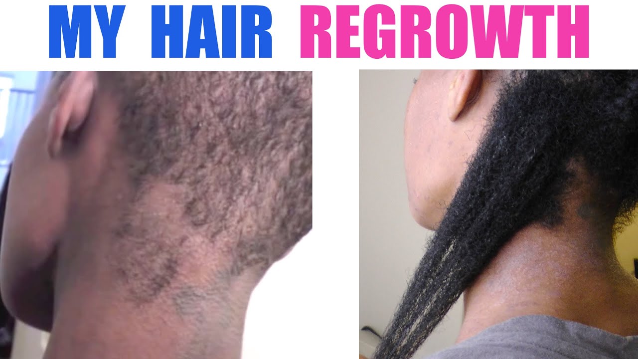 Hair Regrowth | Coconut Oil or Shea Butter Mixture