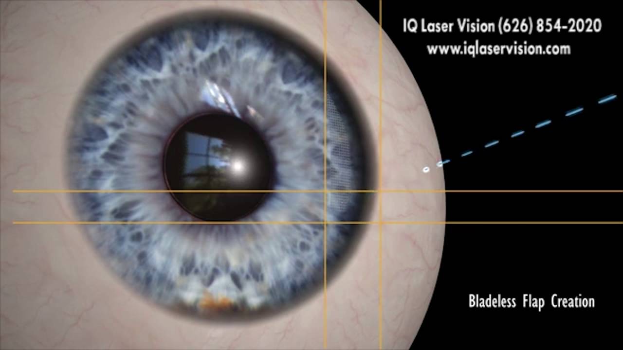 Z LASIK How Bladeless Eye Surgery Works