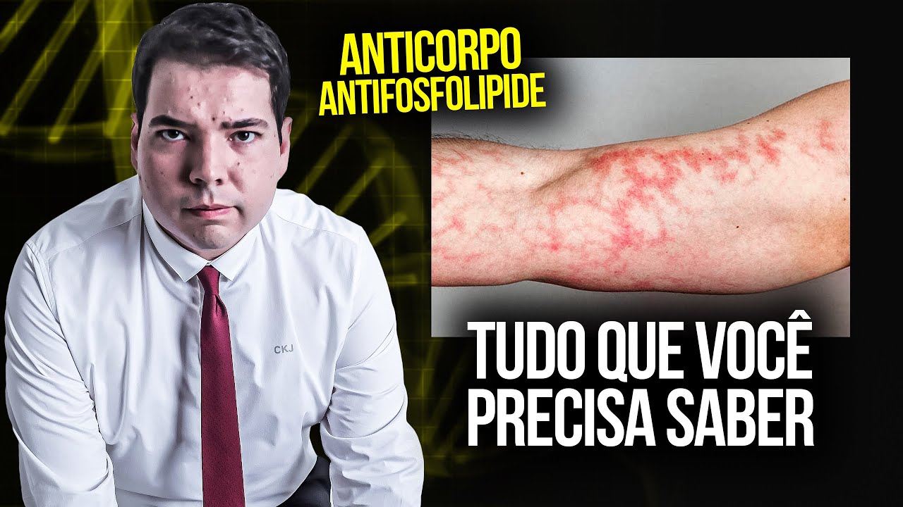 Síndrome do Anticorpo Antifosfolípide (SAF)