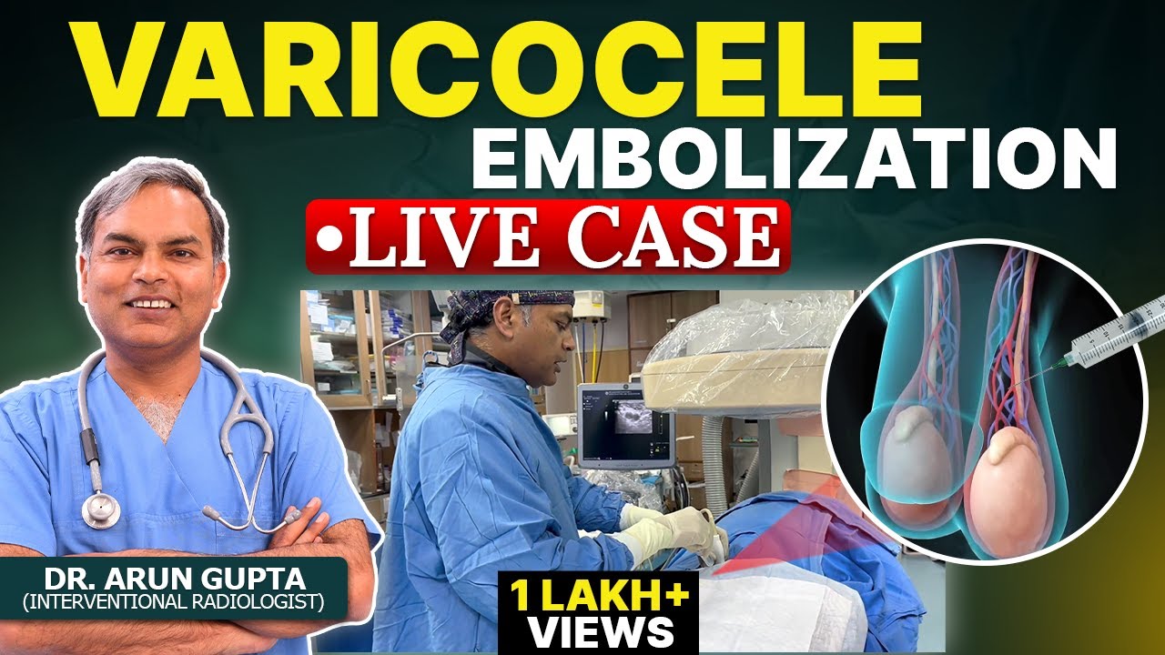 Live Case - Grade 3 Varicocele Embolization | Non-Surgical Treatment of Varicocele | Dr. Arun Gupta