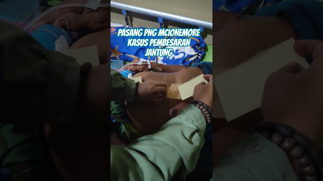 cara pasang png mcionemore pada kasus pembesaran jantung..cuman 3 hari opname 