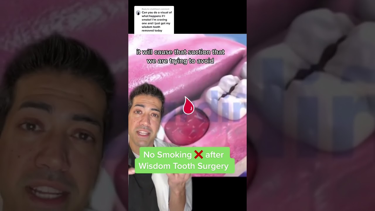 #greenscreenvideo NO SMOKING AFTER WISDOM TOOTH REMOVAL FOR 2 weeks atleast ❌❌❌ #drysocket #wisdomte