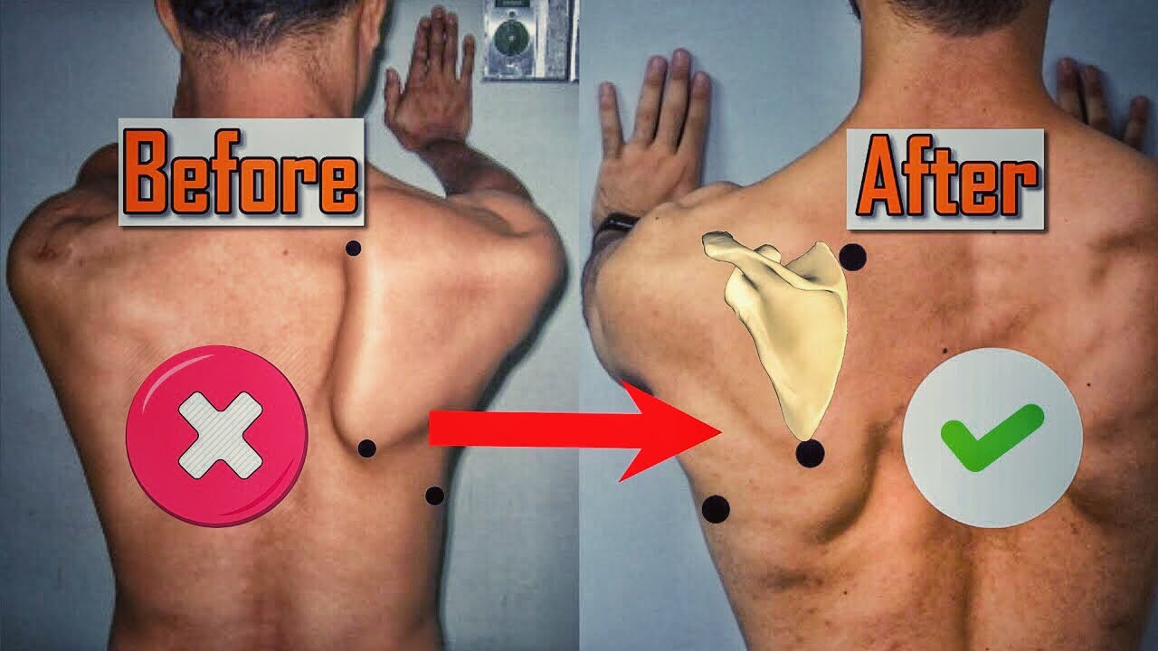 علاج تجنح لوح الكتف - Winging of the Scapula