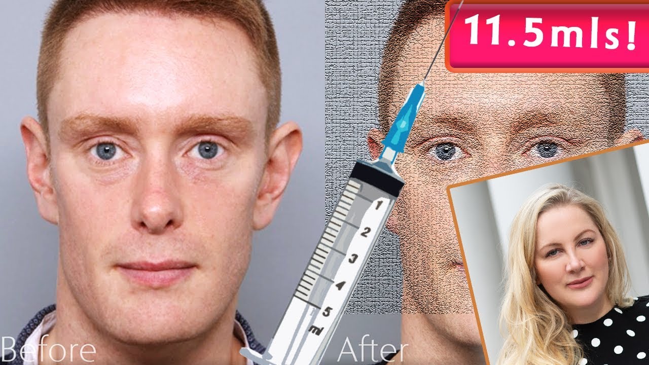 Men's Platelet Rich Plasma (PRP) & Fillers Transformation for this 30-ish Fella!