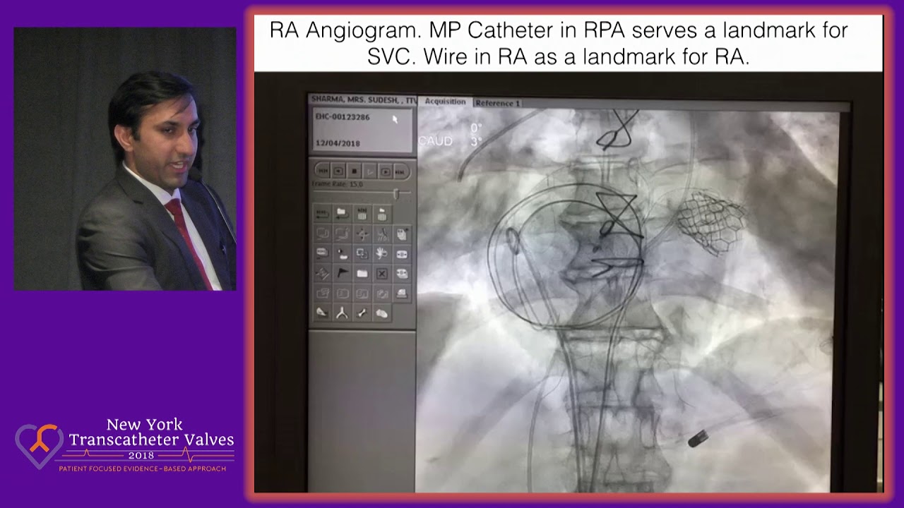 TMVR and Caval Valve Implantation - Dr.  Ravinder Rao