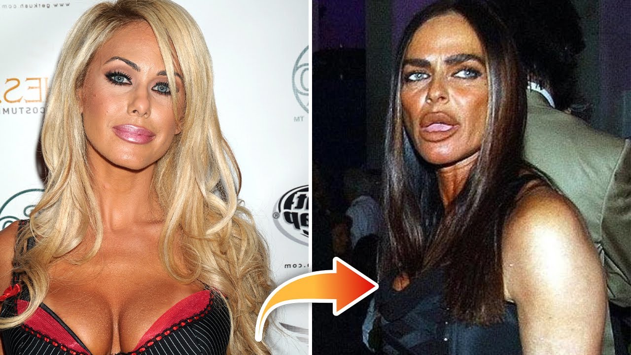 10 WORST Celebrity Plastic Surgery DISASTERS!