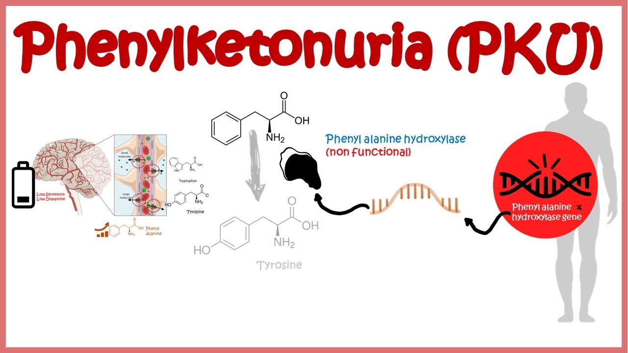 Phenyl Ketonuria ( genetic defects in amino-acid metabolism)