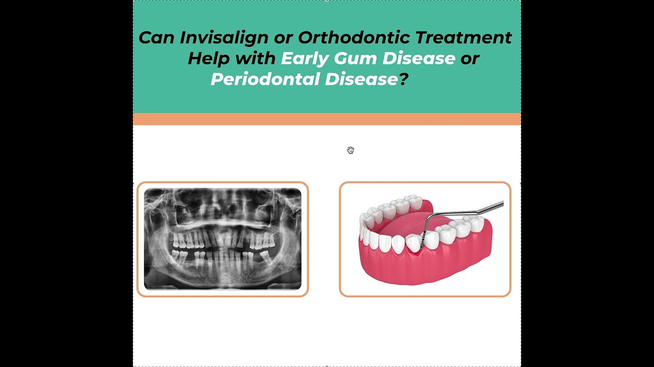 Early Gum Disease and Orthodontics