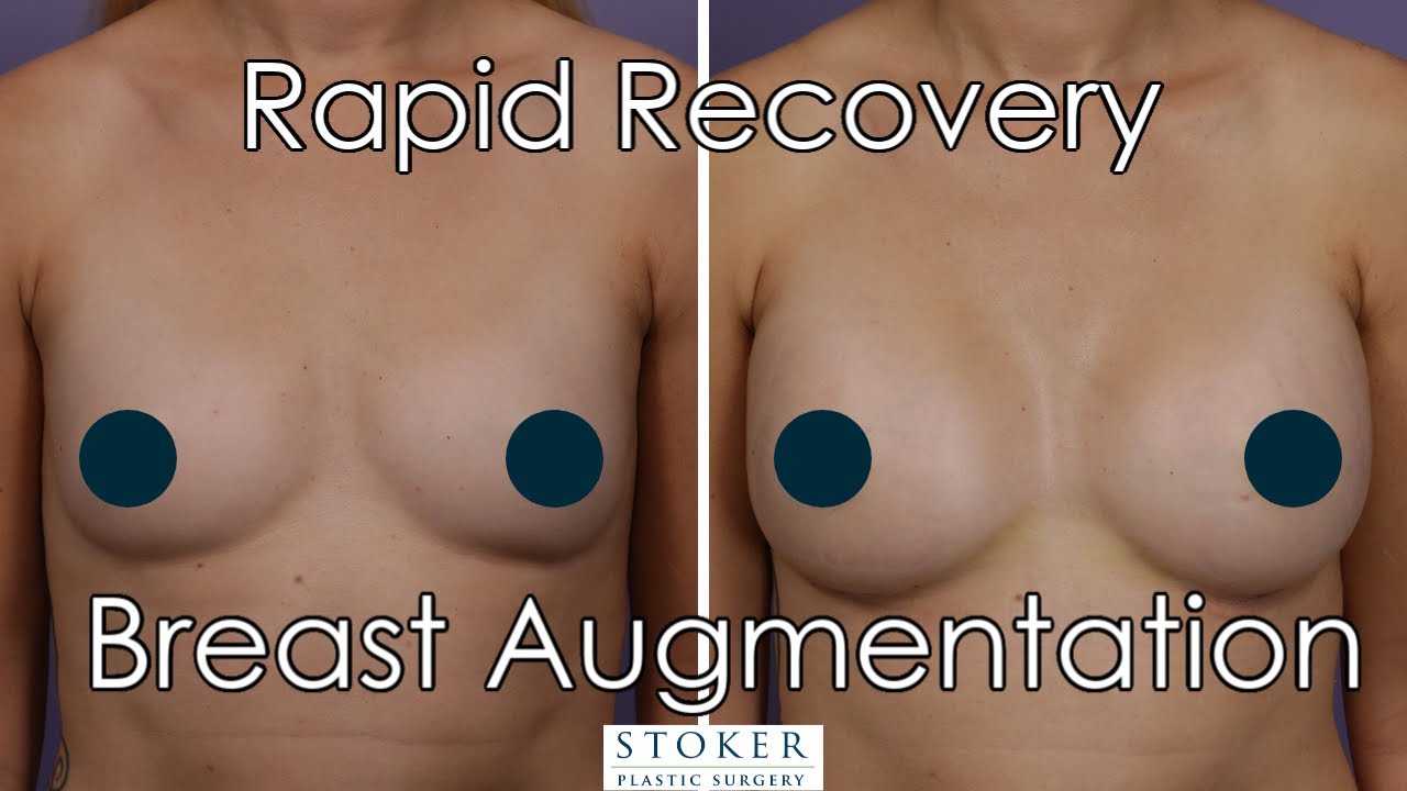 Rapid Recovery Breast Augmentation and Nipple Reduction in Los Angeles by Dr. David Stoker