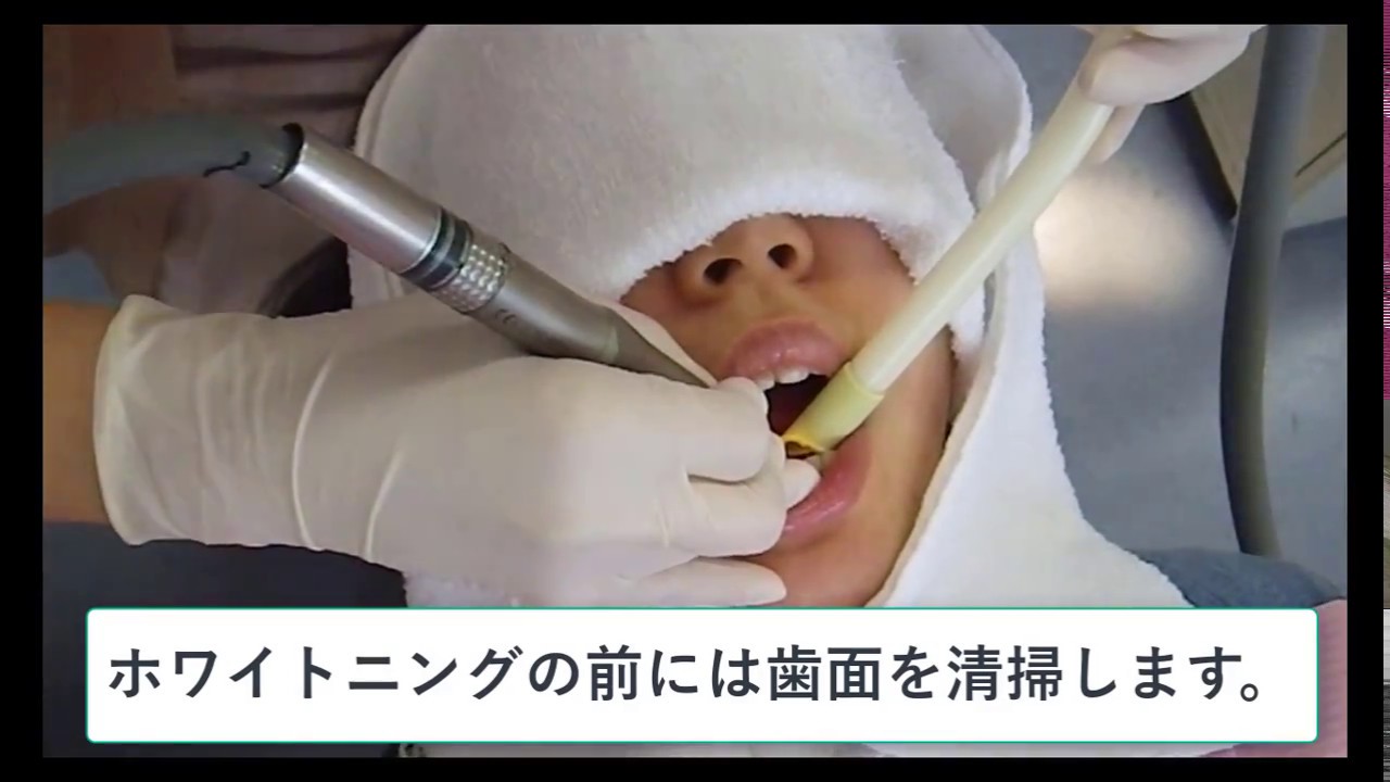 ホワイトニングの実際 よつじ歯科医院 大館 能代 北秋田 秋田 審美 ホワイトニング インプラント