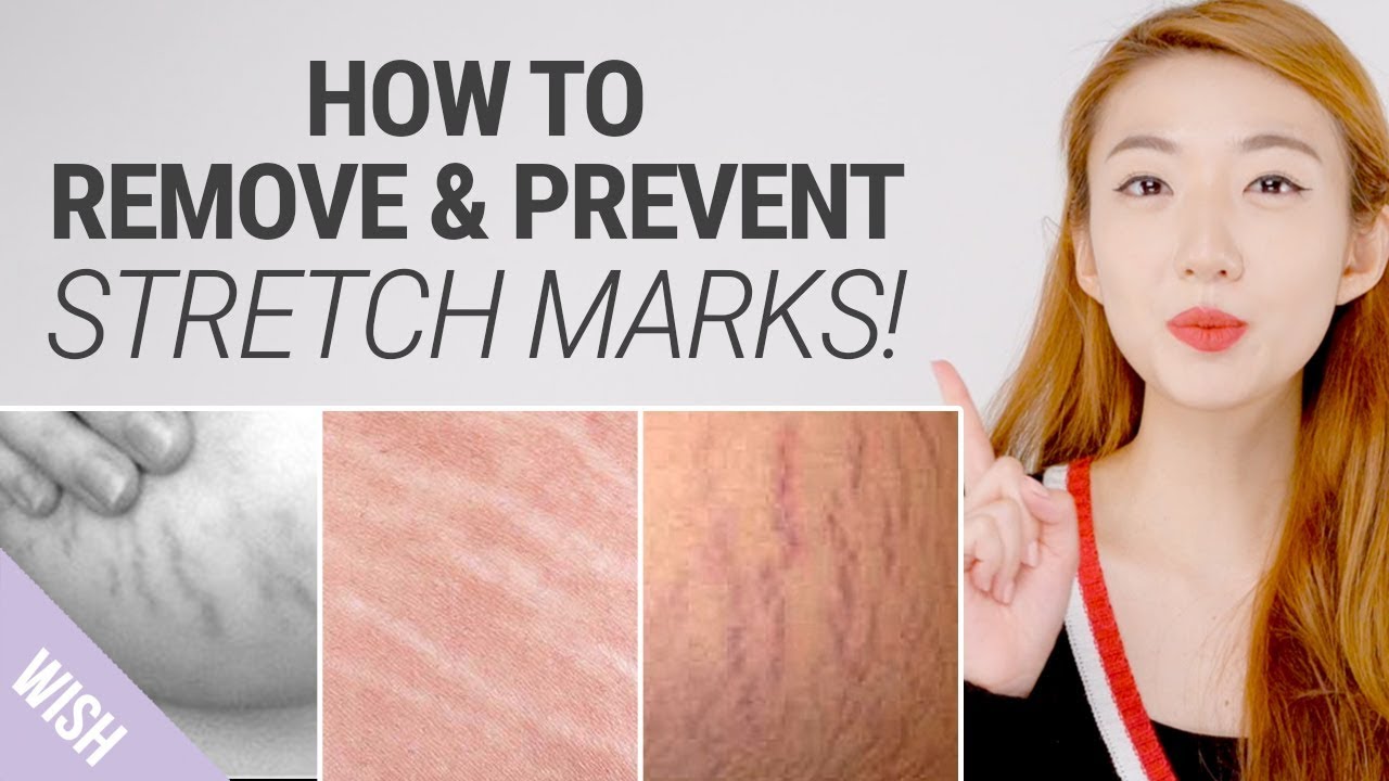 How To Get Rid of Stretch Marks Fast | Natural Remedies for Stretch Mark Removal | What's TRENDing