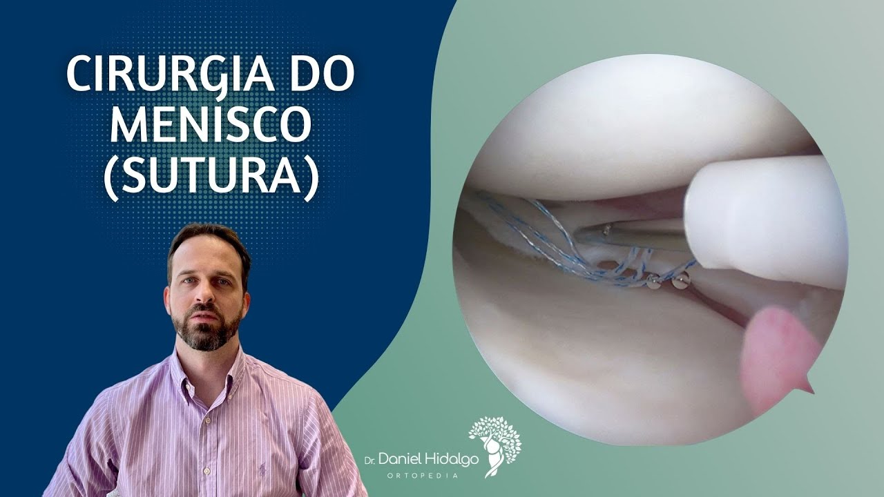 Cirurgia de Menisco - Sutura