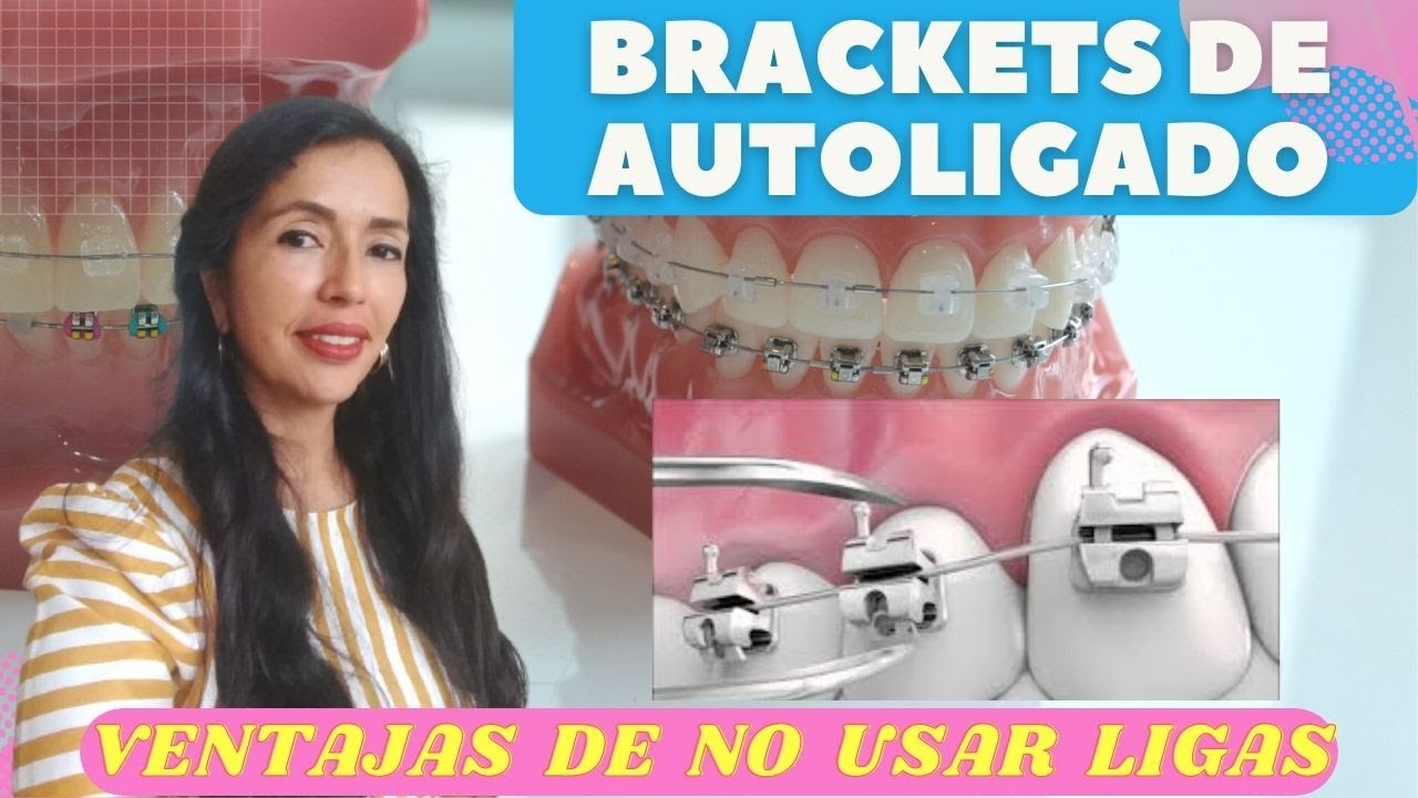 Brackets de Autoligado.  Ventajas de NO usar ligas