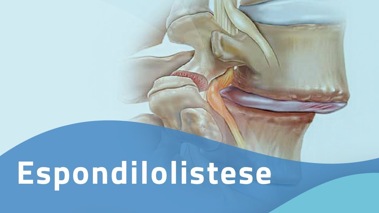 ESPONDILOLISTESE