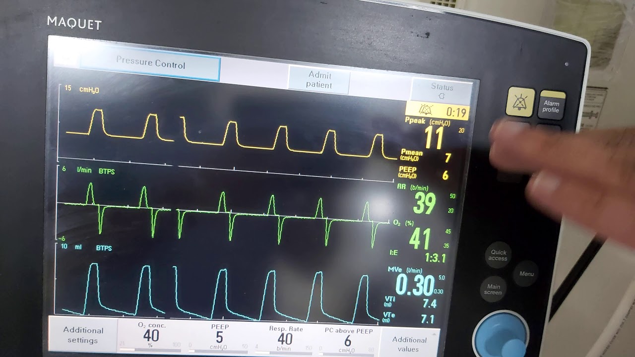workshop 73 How does PRVC ventilation work? pressure regulated volume control, dual control mode,