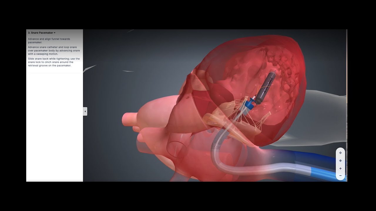 mCRM™ System: EMPOWER™ Leadless Pacemaker Retrieval Demonstration