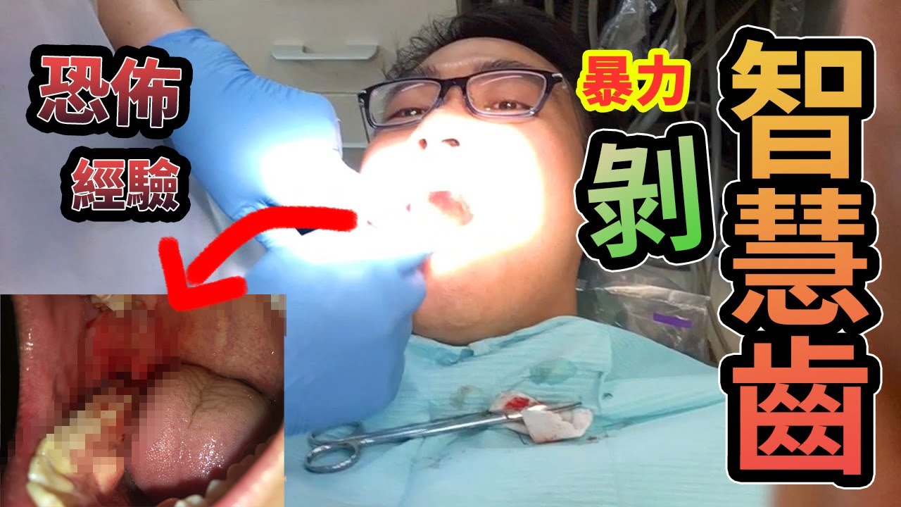 牙痛🦷智慧齒横生➡️唔敢整💉三叉神經線受損？失去知覺！