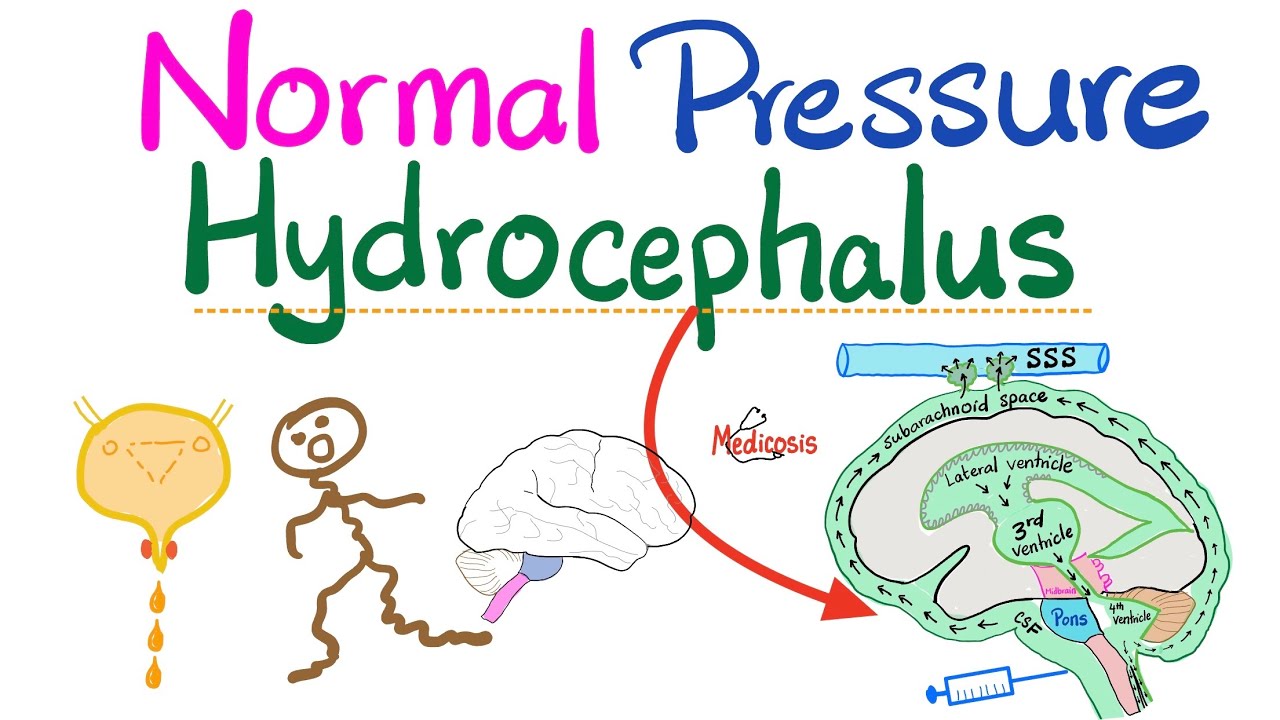 Normal Pressure Hydrocephalus (NPH) - Urinary Incontinence, Ataxia, Dementia (memory loss) - Neuro