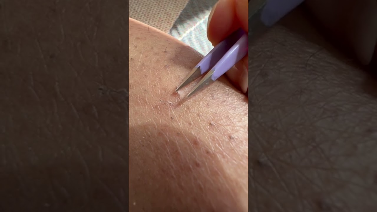 INGROWN Hairs are the Devil 😈 #sugarwax #shorts