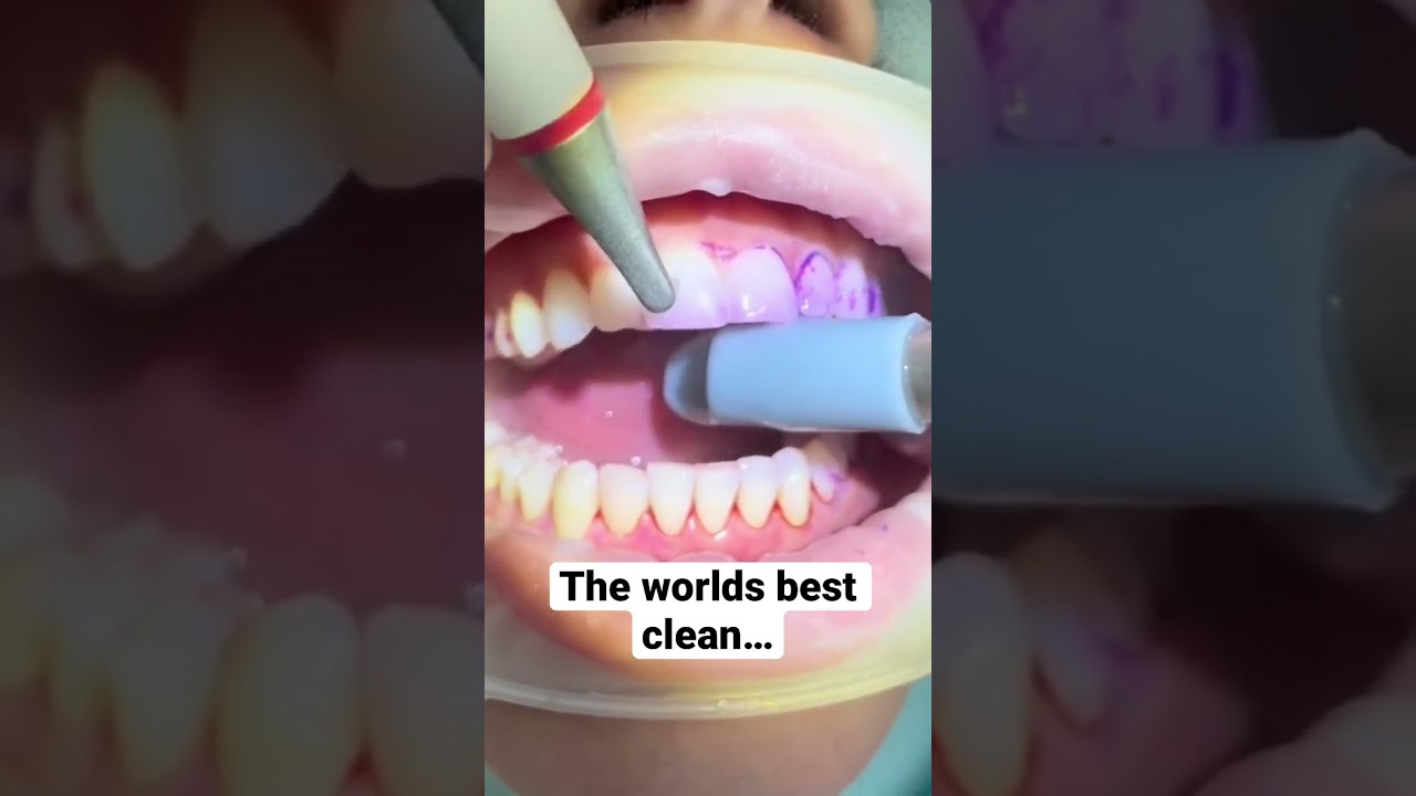 So Satisfying! 🙃#dentistry #ems #airflow #dentalhygiene #clean #satisfying #dental #dentalstudents