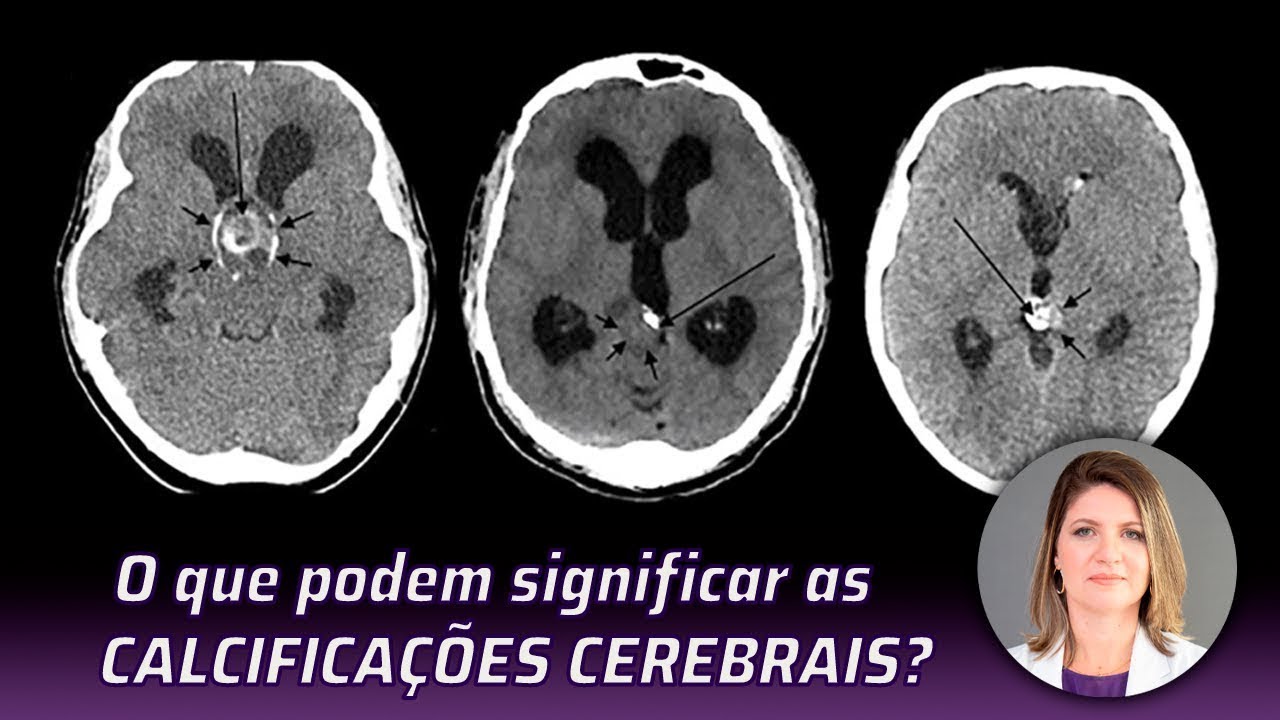 O QUE PODEM SIGNIFICAR AS CALCIFICAÇÕES CEREBRAIS (Atualizado)