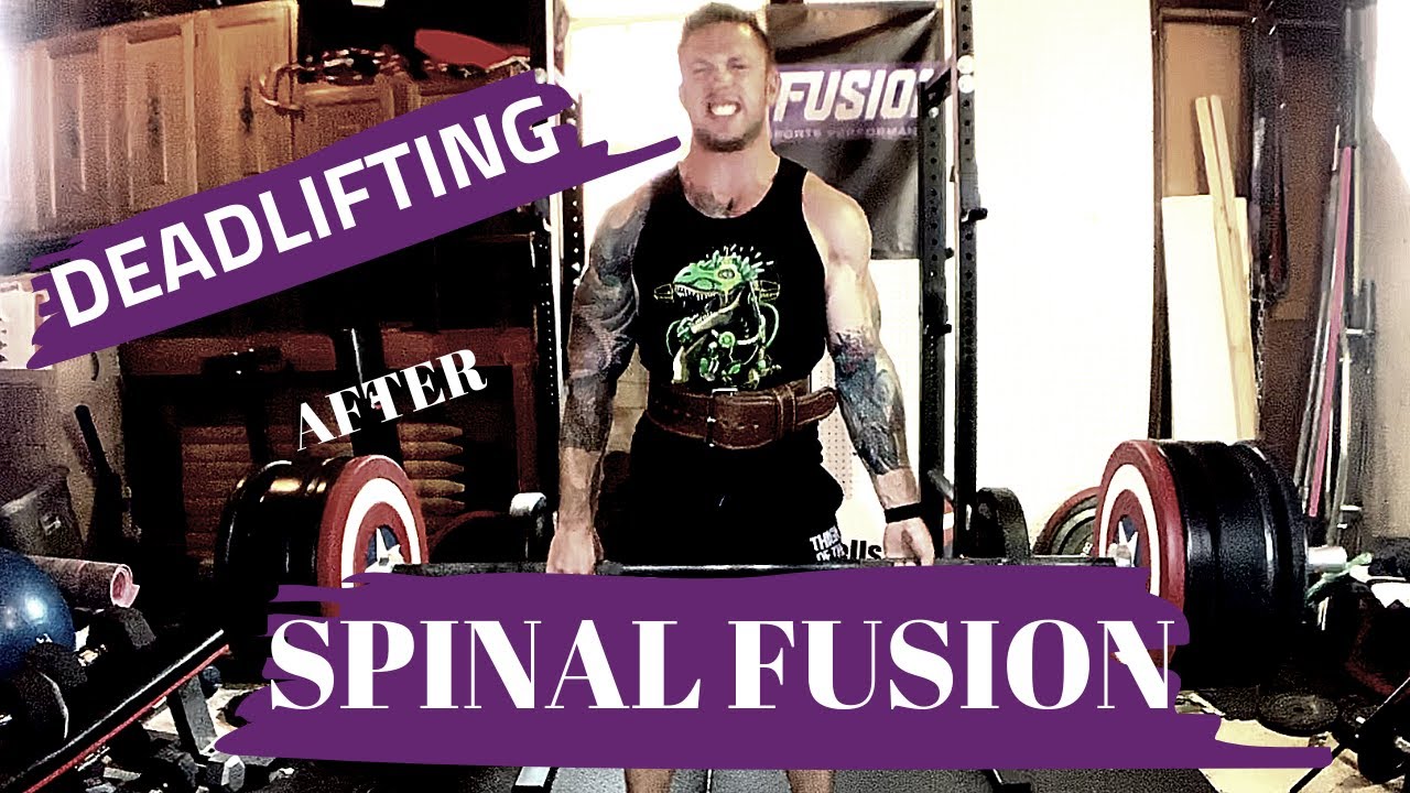 Deadlifting After SPINAL FUSION SURGERY