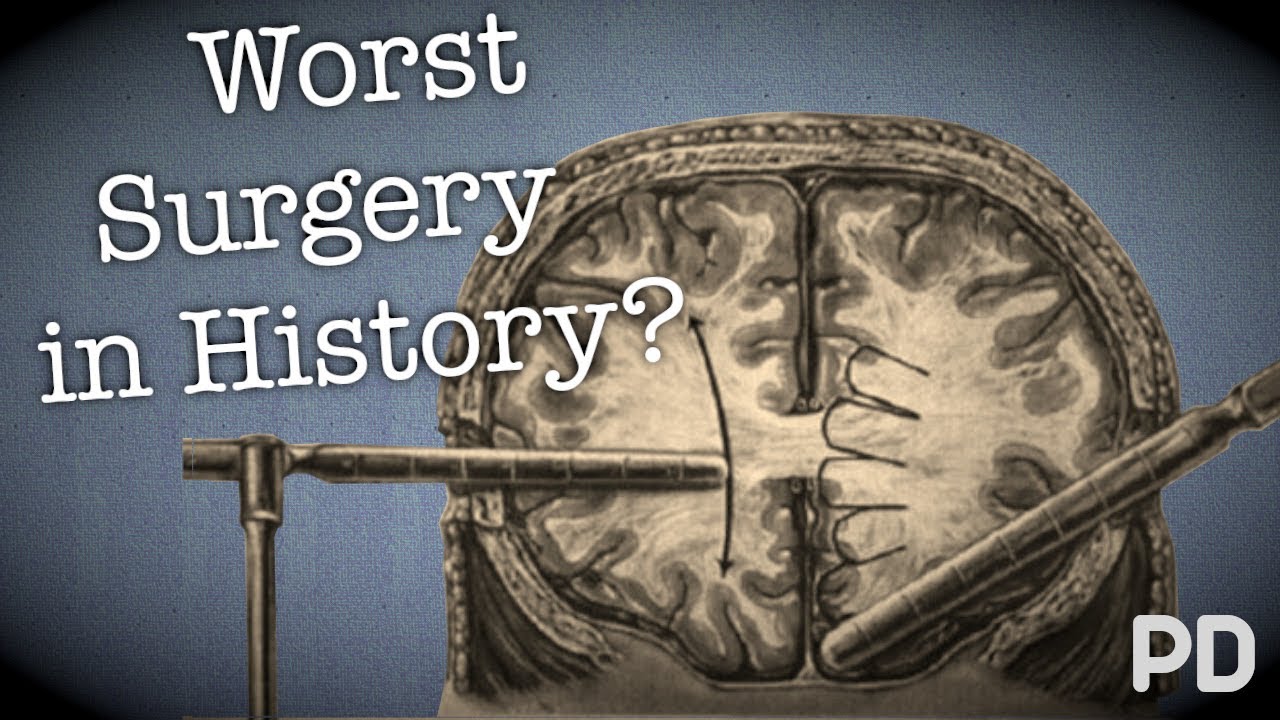 Тёмная сторона науки: лоботомия — самая страшная операция в истории? (Документальный фильм)
