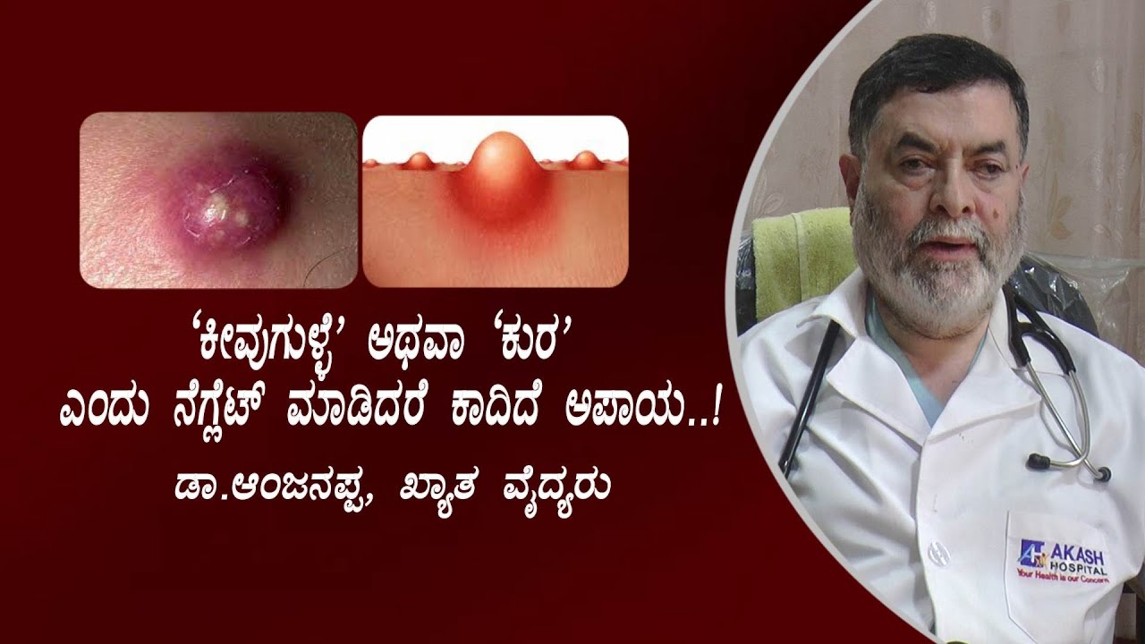 'ಕುರ'ಎಂದು ನೆಗ್ಲೆಟ್ ಮಾಡಿದರೆ ಕಾದಿದೆ ಆಪತ್ತು..!Furuncles and Carbuncles//Dr.Anjanappa