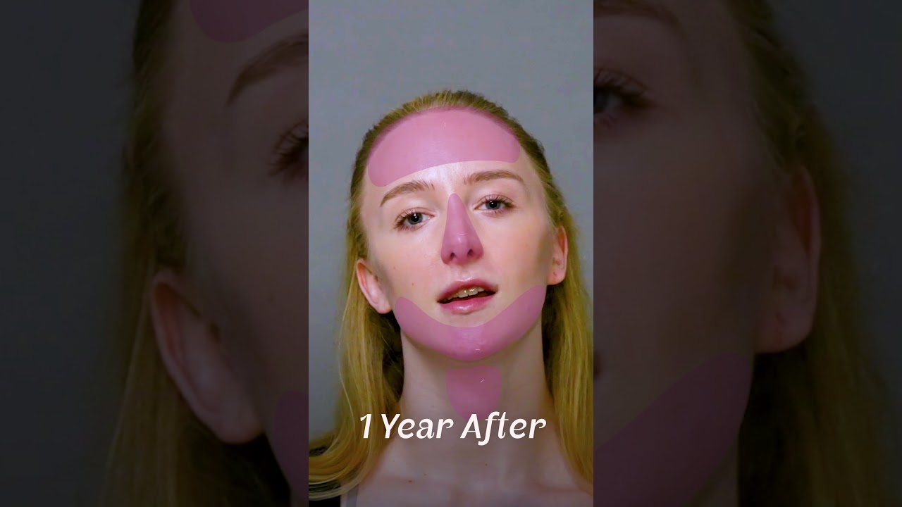 Isla, Canada &mdash; FFS Surgery Stories