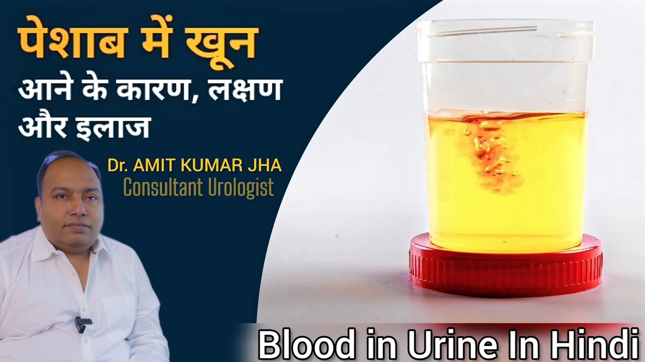 पेशाब में खून आना - Blood in urine (Hematuria) in Hindi | पेशाब में खून आने का कारण, लक्षण और इलाज