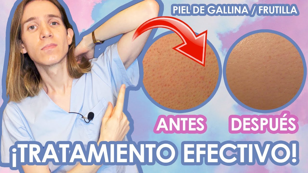 QUERATOSIS PILARIS (Piel de frutilla o gallina) COMO ELIMINARLA