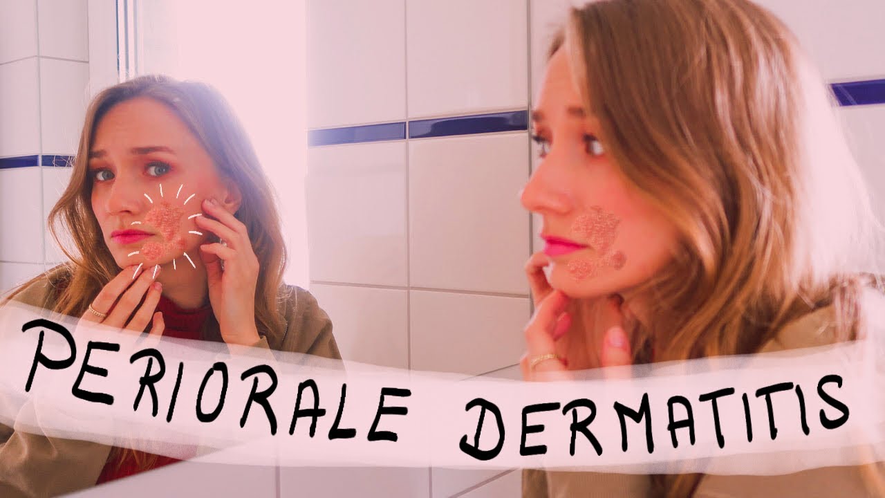 So wirst du deine Periorale Dermatitis los!