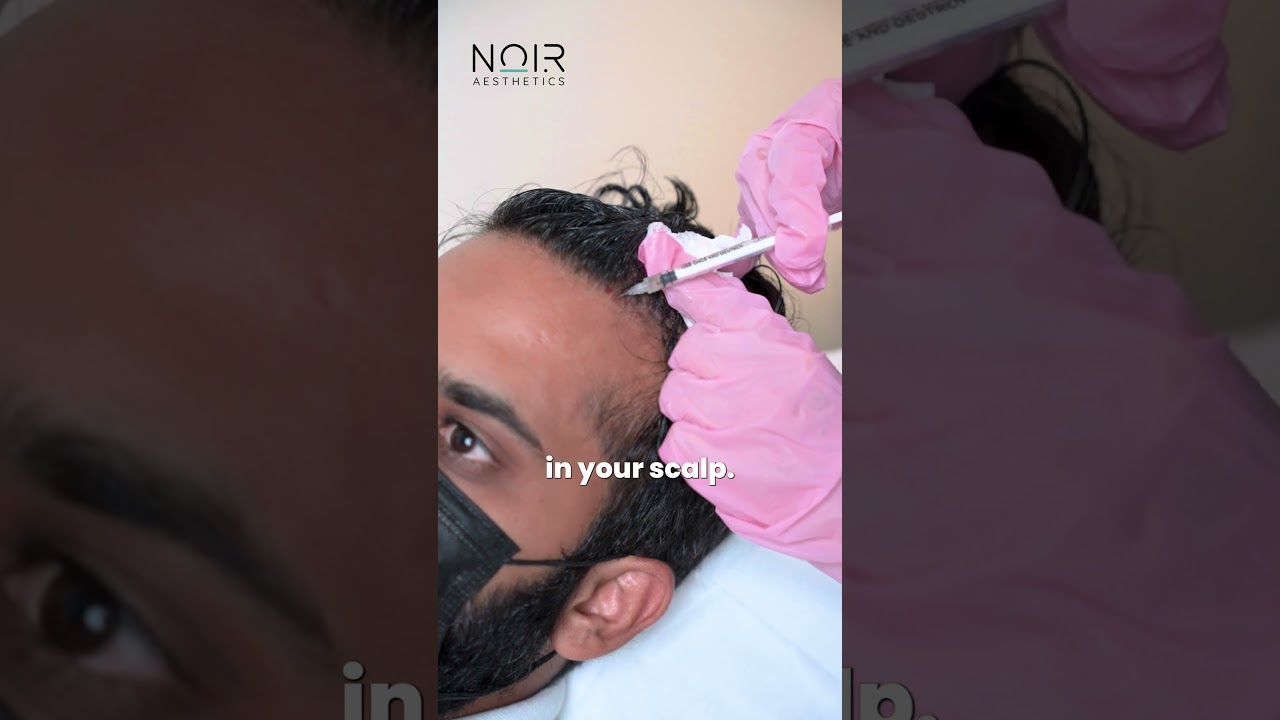 𝗣𝗥𝗣 𝗧𝗿𝗲𝗮𝘁𝗺𝗲𝗻𝘁 𝗮𝘁 𝗡𝗼𝗶𝗿 𝗔𝗲𝘀𝘁𝗵𝗲𝘁𝗶𝗰𝘀!  #noiraesthetics #prp
