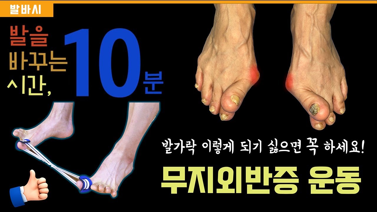 무지외반증에 꼭 필요한 운동 프로그램