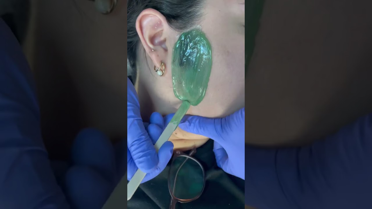 Professional sideburn wax performed by me. Using Nacach hard green wax. #esthetician #waxing